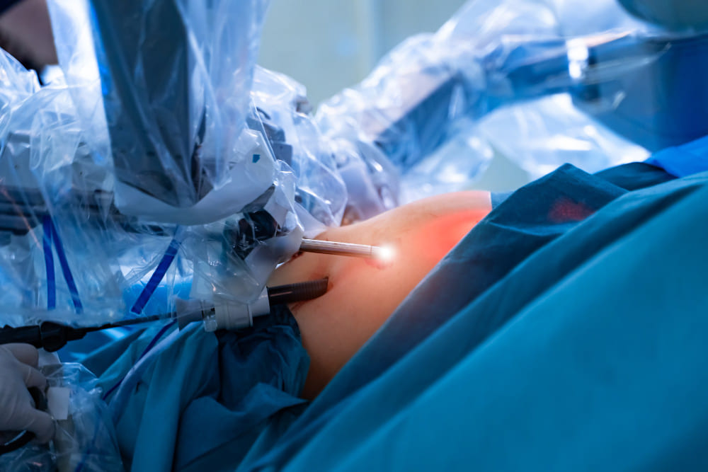 Cirugía de hernia umbilical e inguinal laparoscópica en CDMX